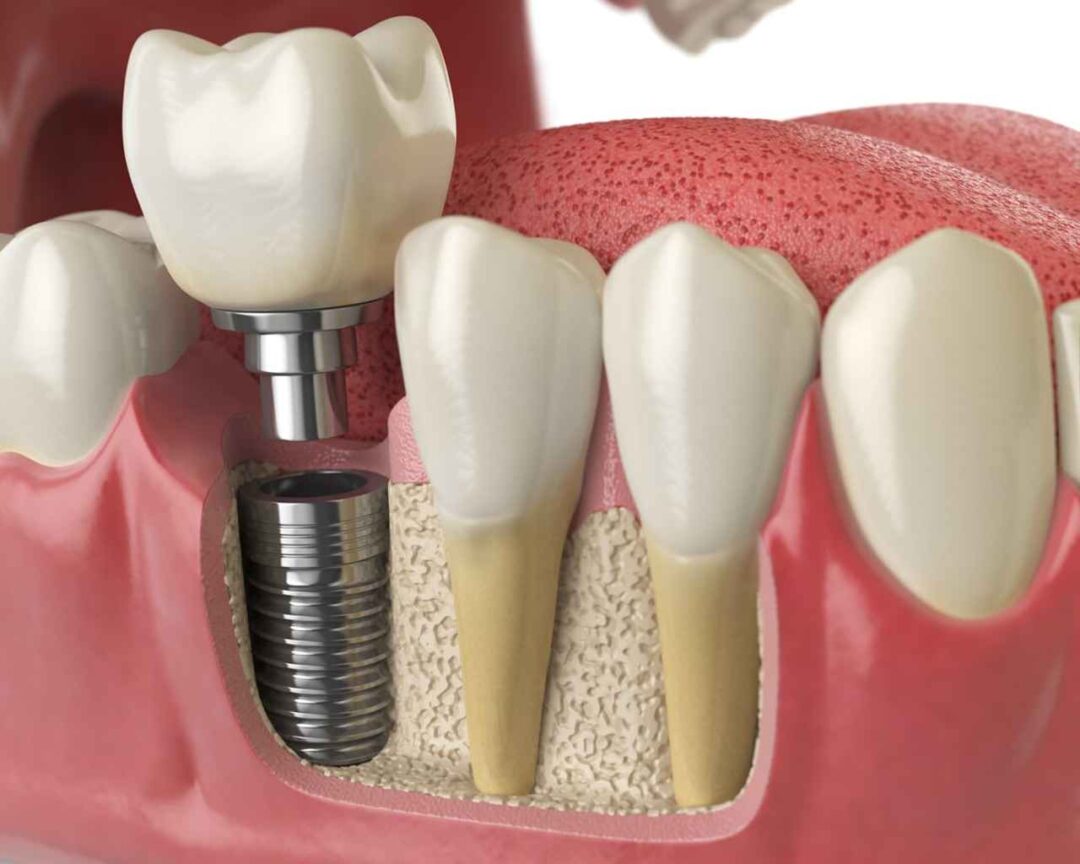 Teeth Implantation